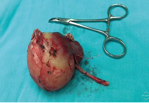 Extracción del riñón derecho con el
tumor. Riñón derecho aumentado de volumen a expensas de una masa en polo
inferior.