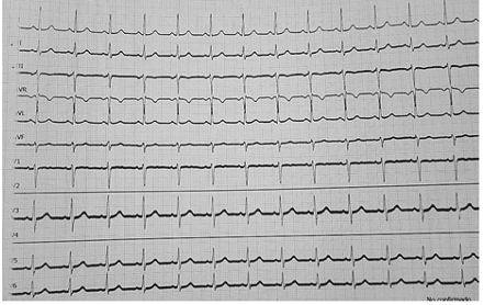 Electrocardiograma postparo
cardiaco: frecuencia cardiaca de 83 lpm, ritmo sinusal, eje cardiaco desviado a
la izquierda, ondas normales.