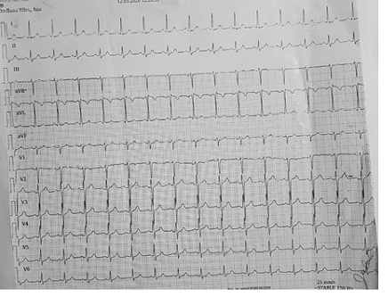 Electrocardiograma antes del alta
hospitalaria: frecuencia cardiaca de 100 lpm, ritmo sinusal, eje electrico con
desviacion a la izquierda.