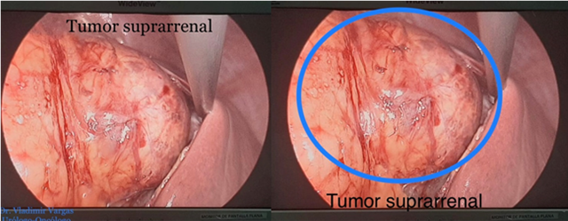 Tumor suprarrenal derecho de gran
tamaño, en contacto íntimo con higado