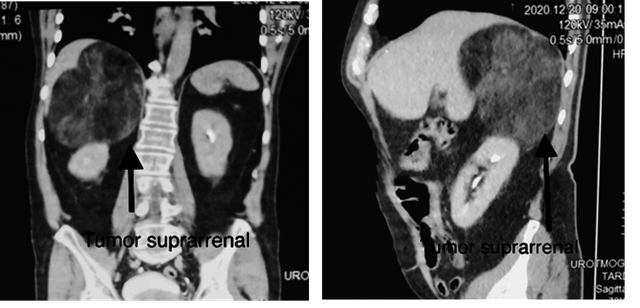Tomografía abdominopélvica contrastada,
en la que se evidencia tumor suprarrenal derecho, sugestivo de mielolipoma
suprarrenal.