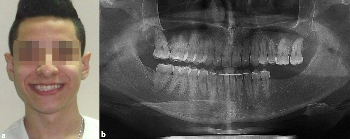 a. Foto Frontal, sin evidencia de asimetrías faciales. b. Regeneración ósea fisiológica normal, finalizado tratamiento ortodóntico