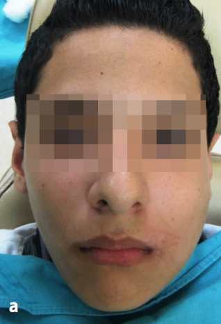 Paciente 13 años con aumento de volumen submandibular