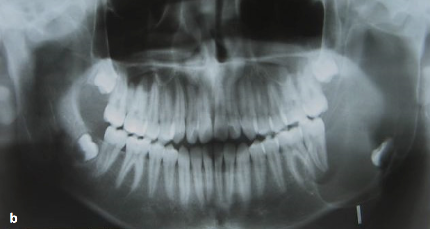 Lesión radiolúcida unilocular en la región del ángulo mandibular izquierdo de 5x3 cm. de diámetro