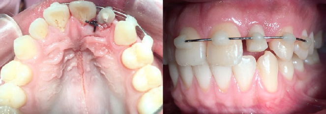 Técnica de extrusión quirúrgica en diente 2-2, ferulización por 3 semanas y sutura interdental más controles semanales.