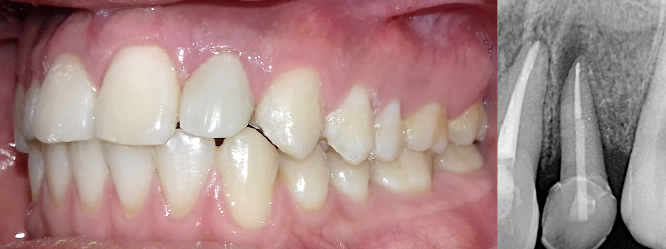 Cementación de corona de cerómero reforzada con porcelana y radiografía final del tratamiento (extrusión quirúrgica, endodoncia, poste de fibra de vidrio y cementación de corona dental).