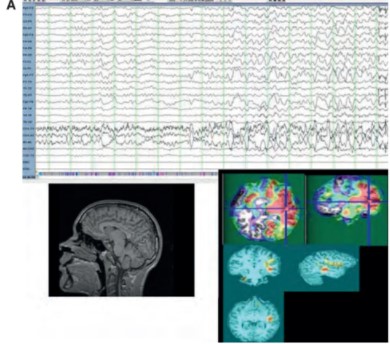 A) Evaluación prequirúrgica en pacientes con epilepsia extratemporal no lesional. Las secuencias ponderadas en T1 y T2 en las imágenes de RMN se consideraron normales. El EEG extracraneal mostró actividad rítmica al inicio ictal en la región frontocentral.
El SPECT realizado en estado
interictal e ictal (bajo monitoreo
de EEG) corregistrado con imágenes de resonancia
magnética (SISCOM) permitió localizar hiperperfusión en el área sensorimotora derecha. B) La electrocorticografía intraoperatoria reveló un patrón de puntas repetitivas en la región pericentral. Potenciales evocados somatosensoriales registrados intraoperato- riamente para delinear la corteza elocuente mostraron reversión de fase en los contactos colocados sobre el área rolandica. El paciente fue sometido a resección focal y la evaluación neuropatológica reportó displasia cortical
focal tipo I según clasificación de la ILAE