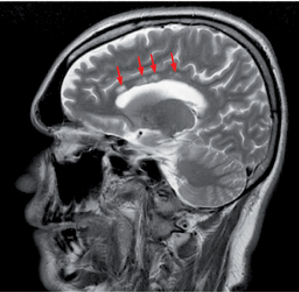 Figura 2. Imagen por resonancia magnética cerebral. En el corte sagital se visualiza lesiones hiperintensas en cuerpo calloso (flechas rojas) en fase de Recuperación de la inversión atenuado de fluido (T2 FLAIR).