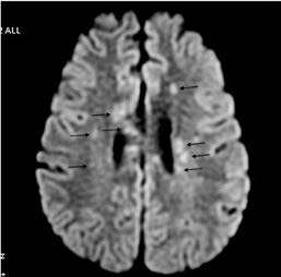 Figura 3. Imagen por resonancia magnética cerebral. En corte axial se muestran lesiones hiperintensas en áreas subcorticales (flechas negras), secuencia de difusión (DW1) de estudio control.