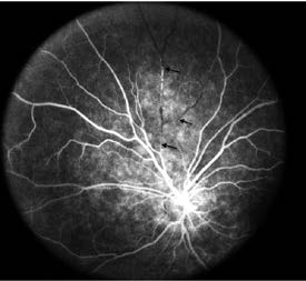 Figura 4. Angiografía retiniana de fluorescencia. Se observa estrechez de arterias en arcada nasal superior/inferior con zonas de
infartos (flechas negras).