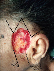 Surgical marking around the primary defect