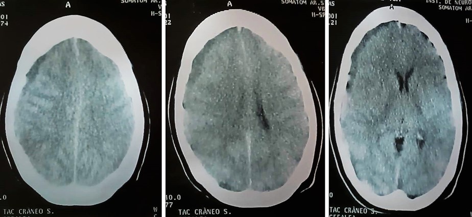 hematoma subdural que une las venas