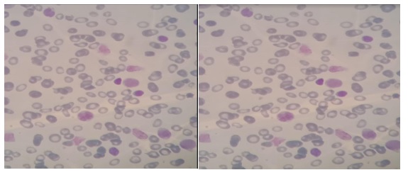 Frotis de sangre Periférica, con evidencia de blastos
con núcleos cerebriformes.