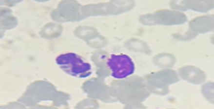 Frotis de sangre periférica en el que se evidencian inclusiones citoplasmáticas en células de línea blanca