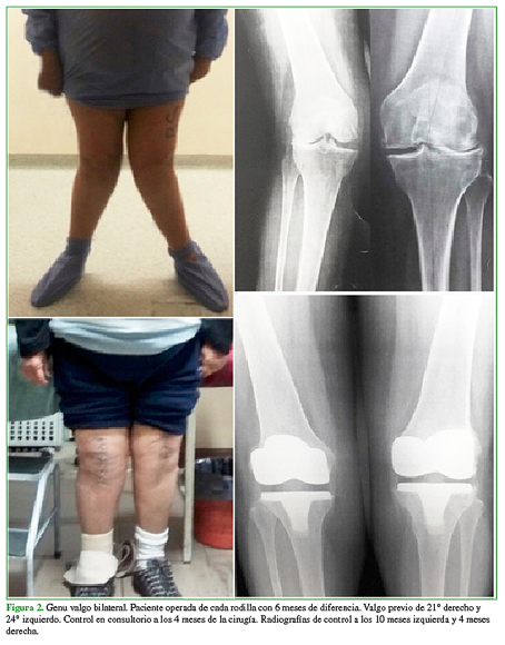 Caso Clínico: Artrosis de rodilla con varo severo que requiere dispositivos  especiales - Surbone