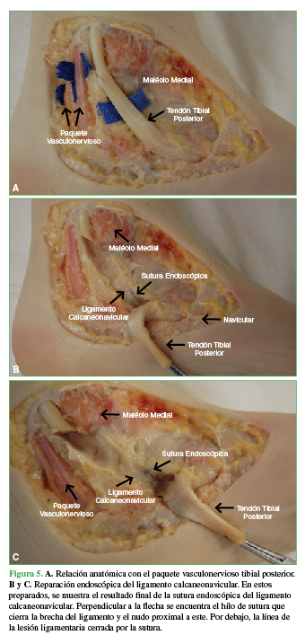 Endoscopic Repair of the Superficial Deltoid Ligament and Spring