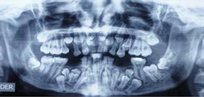 dientes de disostosis cleidocraneal