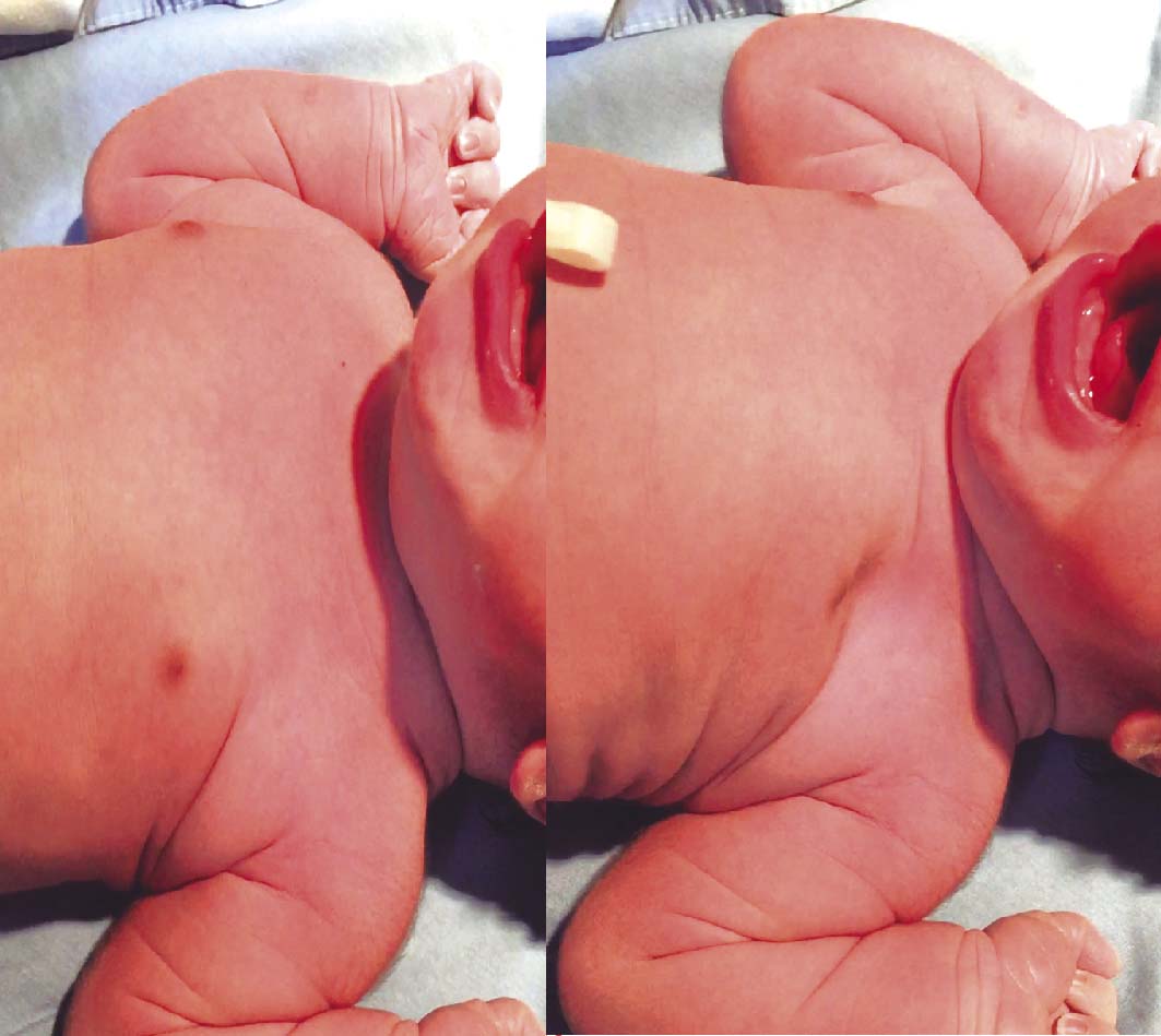 Tórax del recién nacido donde se
evidencia la respiración paradójica 
