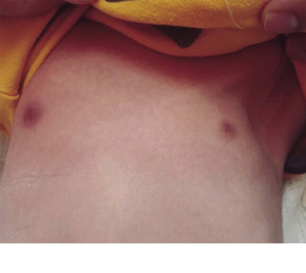 Tórax del recién nacido donde se
muestra la hipoplasia del pezón y asimetría del tórax.