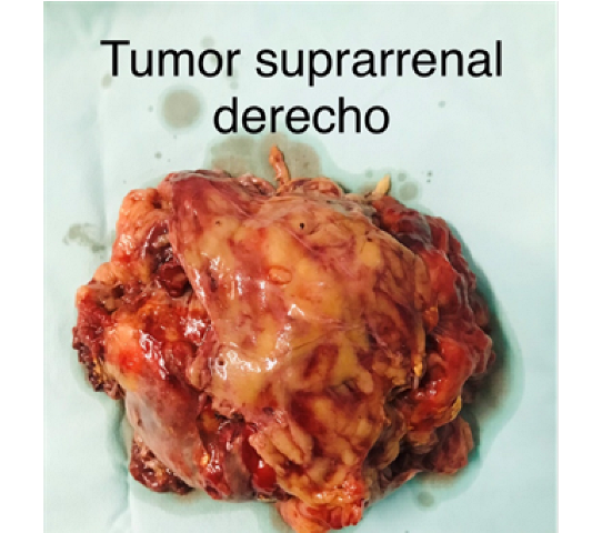 Tumor suprarrenal derecho