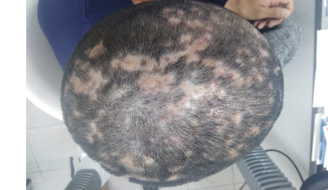 Posterior a dos ciclos de antibiótico,
lesiones anulares de áreas de alopecia, algunas otras placas con
repilificacion, ya sin signos flogisticos.