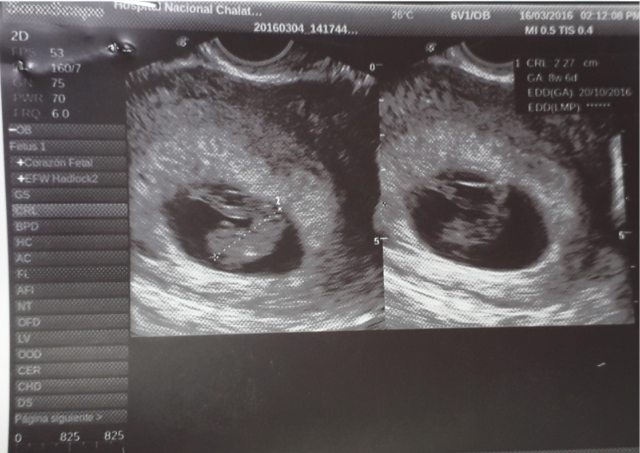 Ultrasonografía transvaginal embrión de 8 semanas