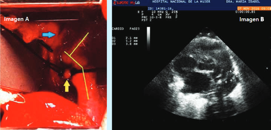 a: Vista panorámica de una toracotomía lateral izquierda, donde se aprecia la disección en planos de la aorta. La flecha azul señala el nervio vago. La flecha amarilla muestra el DAP ligado a ambos lados por suturas. La línea continua en amarillo indica el trayecto del cayado aórtico. b: Imagen fija de una ventana ecocardiográfica de eje corto paraesternal izquierdo que muestra una DAP (+) y sus medidas en milímetros.