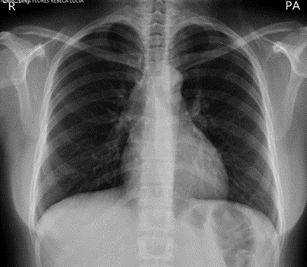 Figura 5 Radiografía
de Tórax. 