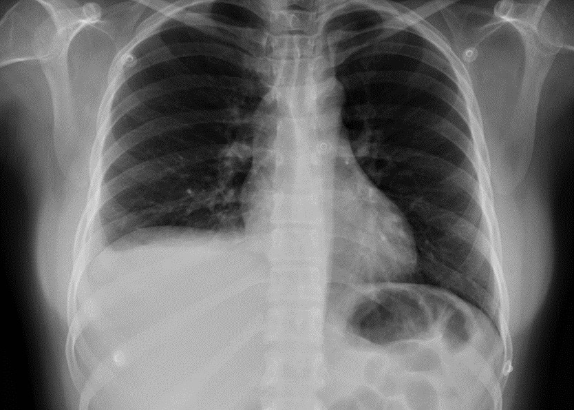 Figura 1. Radiografía de Tórax. Derrame pleural derecho.