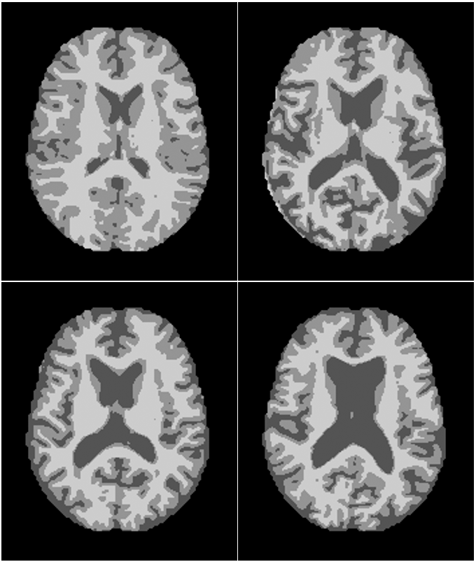 Patrón de agrandamiento de los cuencos cerebrales y
adelgazamiento de la materia blanca en diferentes categorías de Alzheimer
