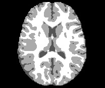 Resonancia magnética cerebral de un paciente
sano