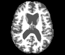 Resonancia magnética cerebral de un paciente
con Alzheimer en estado Leve 

 