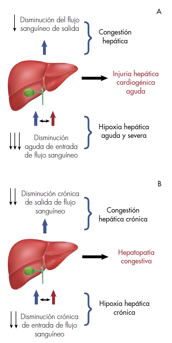 Mecanismos de injuria hepática en falla cardiaca. (A) La injuria hepática cardiogénica aguda se desarrolla posterior a la hipoxia hepática. (B) La hepatopatía congestiva es el resultado de la congestión hepática crónica asociada a hipoxia hepática crónica. Tomado y modificado [3].
