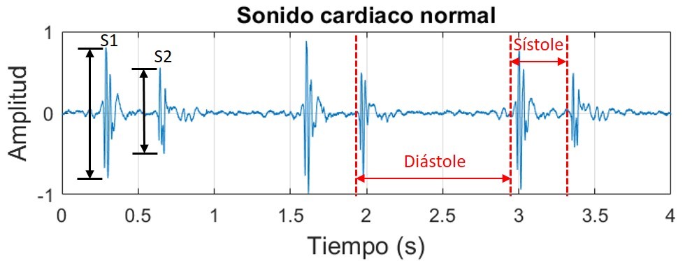 Señal de un sonido cardiaco normal con dos componentes: S1 y S2.