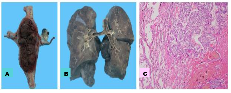 Figura 2. Caso
4. Coriocarcinoma en útero con metástasis pulmonares.