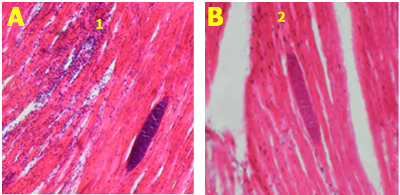 Infiltacion leucositaria sección longitudinal y
transversal en músculo cardiaco de camélido. Tinción con hematoxilina y eosina.
Aumento 10X