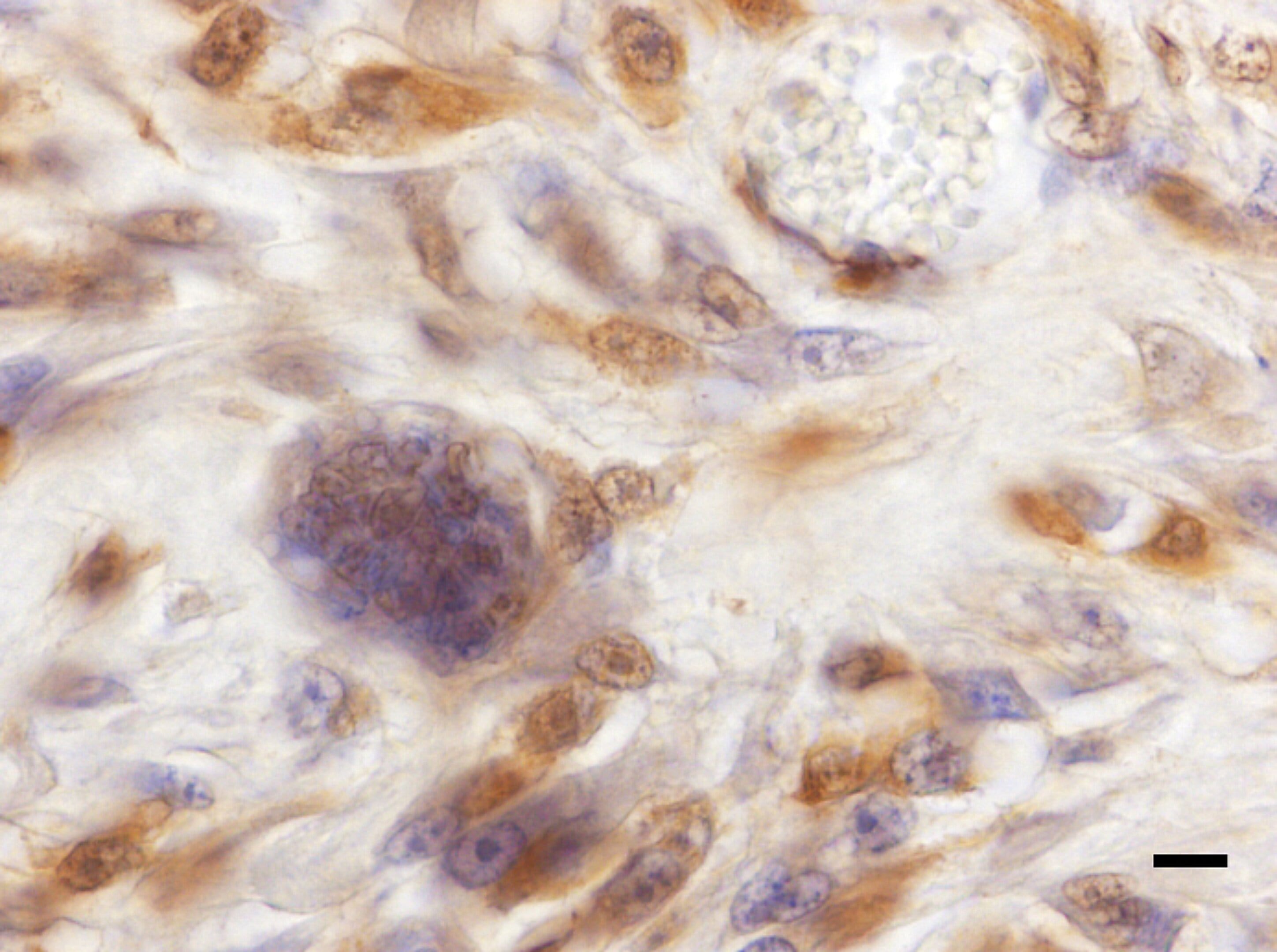 Sarcoma pleom&oacute;rfico (Hendrick, 2017)