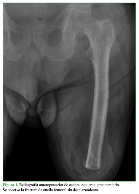 Radiografía anteroposterior de cadera izquierda, preoperatoria.