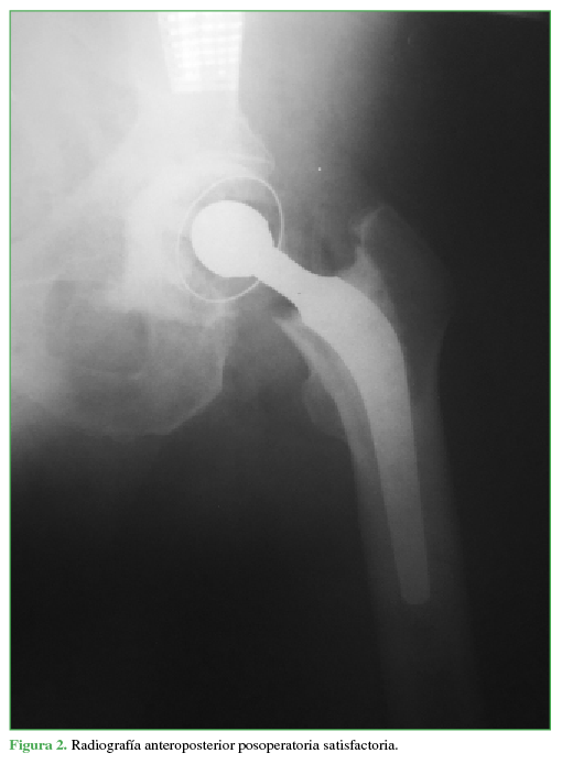 Radiografía anteroposterior posoperatoria satisfactoria.