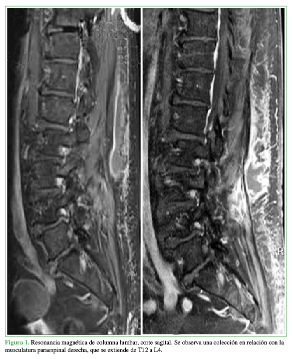 Resonancia magnética de columna lumbar, corte sagital.