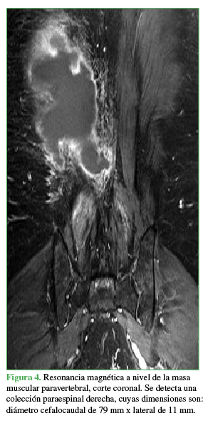 Resonancia magnética a nivel de la masa muscular paravertebral, corte coronal,