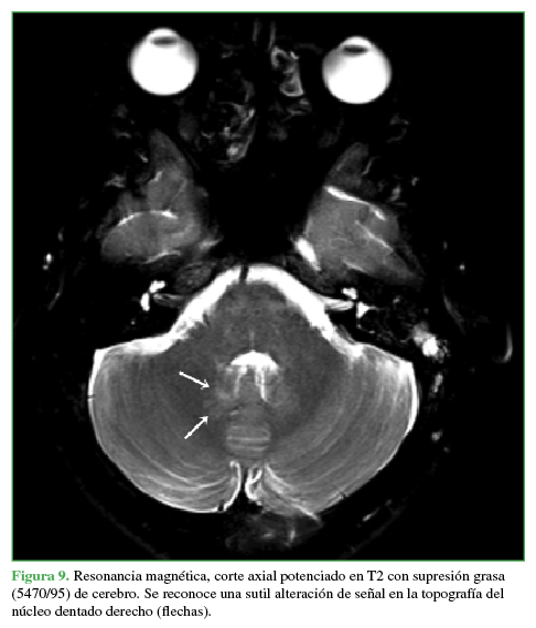 Resonancia magnética, corte axial potenciado en T2 con supresión grasa (5470/95) de cerebro.