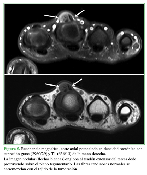 Resonancia magnética, corte axial potenciado en densidad protónica con supresión grasa (2960/29) y T1 (636/13) de la mano derecha.