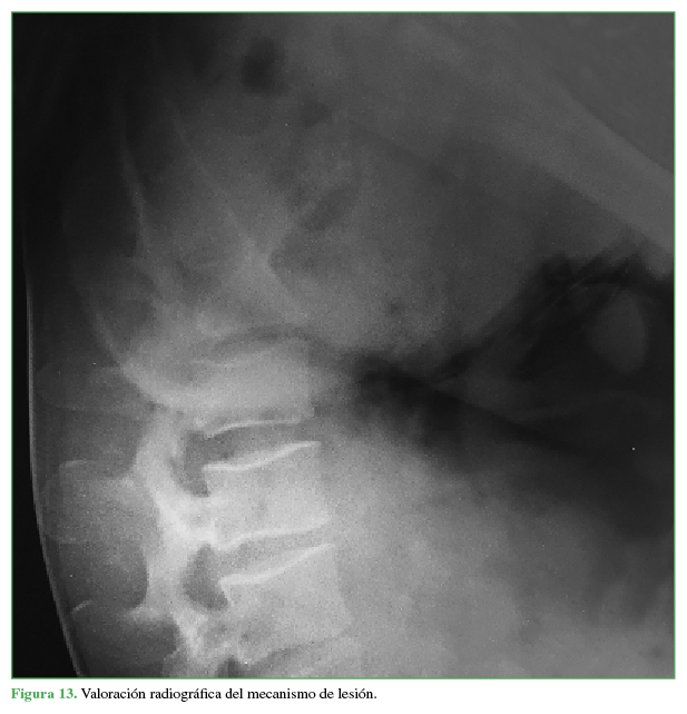 Valoraci&oacute;n radiogr&aacute;fica del mecanismo de lesi&oacute;n.
