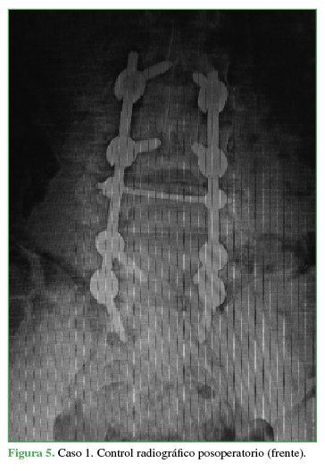 Control radiogr&aacute;fico posoperatorio (frente).