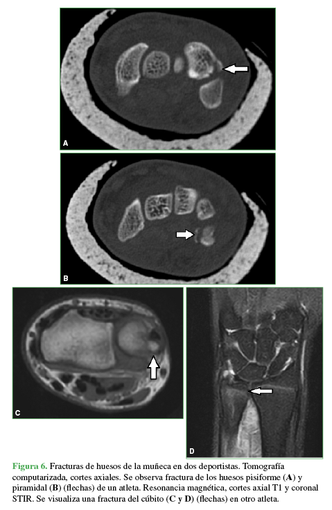 Fractura de huesos de la mu&ntilde;eca en 2 deportistas. Tomograf&iacute;a computarizada, cortes axiales.