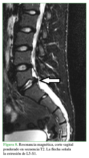 Resonancia magn&eacute;tica, corte sagital ponderado en secuencia T2.