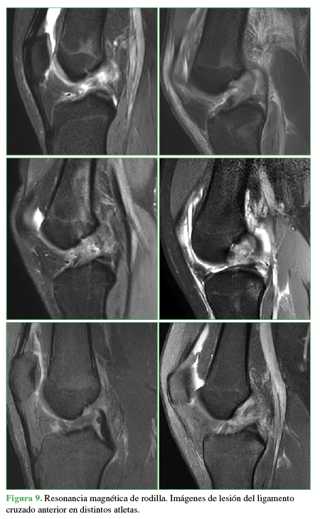 Resonancia magn&eacute;tica de rodilla.
