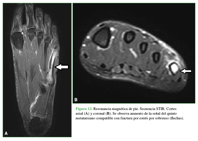 Resonancia magn&eacute;tica de pie. Secuencia STIR. Cortes axial (A) y (B)