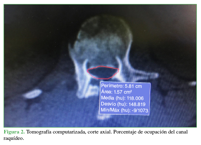 Tomografía axial computarizada, corte axial.